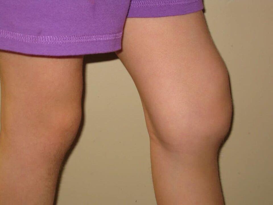 Патология на коляното с напреднала артроза