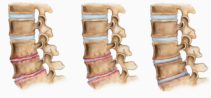 Деформацията на междупрешленните дискове при остеохондроза може да причини болки в гърба