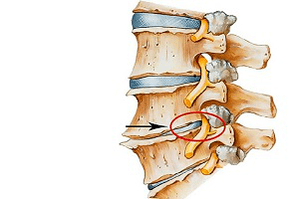 притиснат диск на гръбначния стълб като причина за цервикална остеохондроза