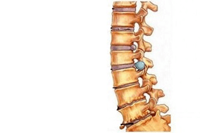 промени в гръбначния стълб на различни етапи от развитието на цервикална остеохондроза